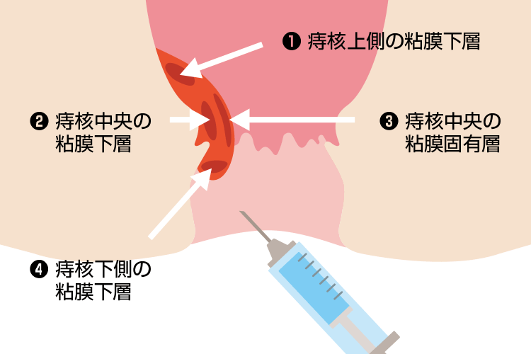 いぼ痔