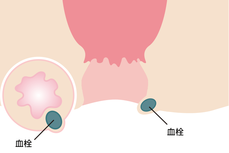 血栓性外痔核