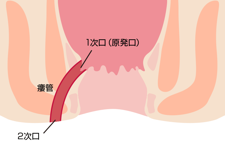 痔瘻